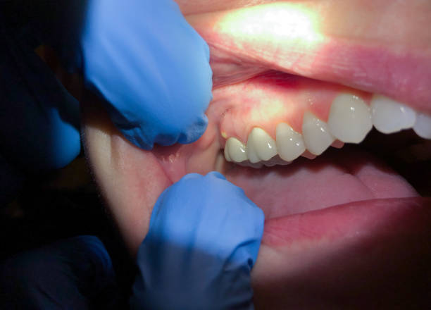 Best Emergency Tooth Extraction in Sunnyvale, TX